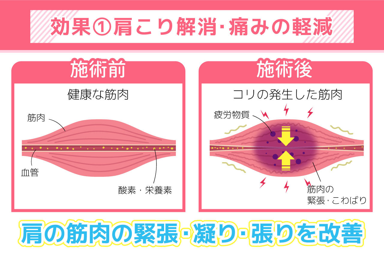 効果①：肩こり解消・痛みの軽減